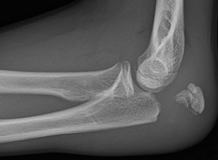 Treating Sprains, Strains, and Fractures Feature Image